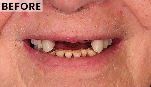 Before – Multiple Tooth Replacement