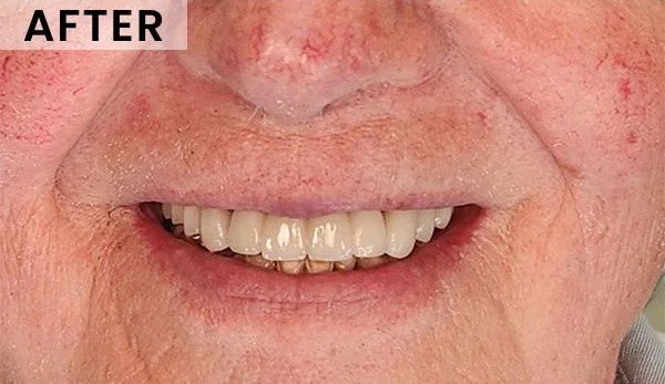 After – Multiple Tooth Replacement